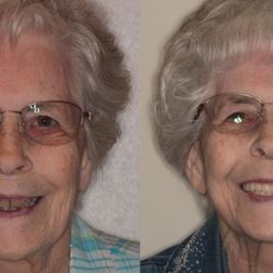 El Dorado Family Dental - Before and after full mouth dental implant on  our lovely patient