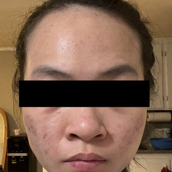 Oasis Skin Clinic - After - Skin Care Near Me - Garden Grove, California