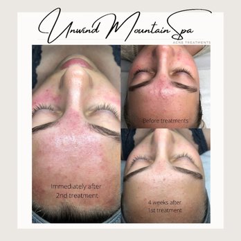 Unwind Mountain Spa - Acne series - Massage Near Me - McCall, Idaho Unwind Mountain Spa - Acne series - Massage Near Me - McCall, Idaho