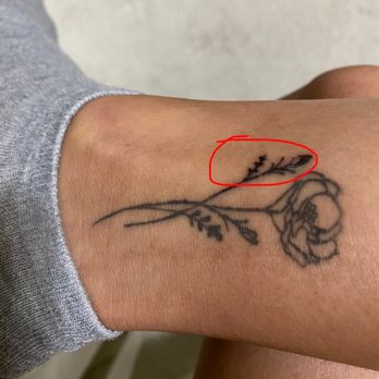 Flawless Skin Center - Part of tattoo that Gali burned. - Laser Hair Removal Near Me - Burbank, California