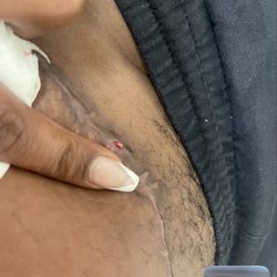 A stitch forcing way out