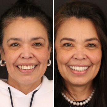 Britely Dentures + Implants Studio - Final result of full mouth dental implants! - Oral Surgeons Near Me - Surprise, Arizona