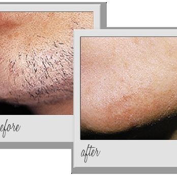 Miami Body Aesthetics - Before and After 6 Sessions of Laser Hair Removal - Laser Hair Removal Near Me - Miami, Florida