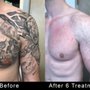 Photo of Tattoo Removers Ink