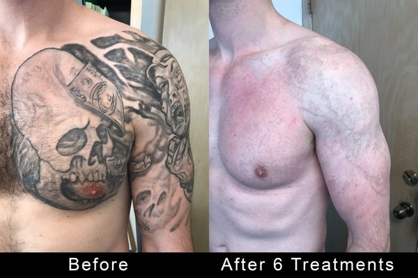 painless b12 injections B12 Shots at Home: How, Where & How Often to Inject Yourself