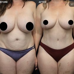 Saba Motakef, MD - Tummy Tuck with liposuction 360, Explant and Breast lift with Auto Augmentation
