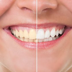 Bluebird Family Dentistry & Orthodontics - Teeth Whitening Northglenn, CO