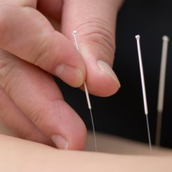 Almond Wellness Centre - Acupuncture treatment