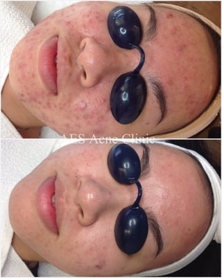 AES Acne Clinic by null