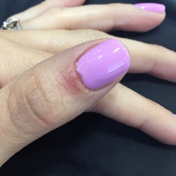 VN Nails - My wound from her cuticle cutting - Nail Salons Near Me - Miami, Florida VN Nails - My wound from her cuticle cutting - Nail Salons Near Me - Miami, Florida