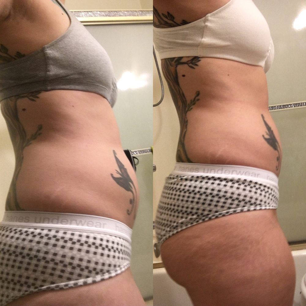 Laser Sculpture - Laser Hair Removal Near Me - Tarzana, California Laser Sculpture - Laser Hair Removal Near Me - Tarzana, California