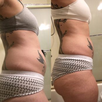 Laser Sculpture - Laser Hair Removal Near Me - Tarzana, California Laser Sculpture - Laser Hair Removal Near Me - Tarzana, California