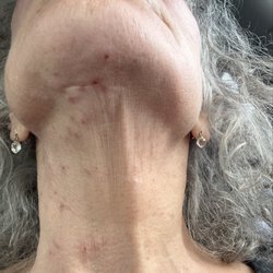 Jennifer Day Spa - Welts and oozing sores from High Frequency facial.