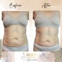 Photo of Body Contouring Beauties