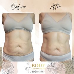 Body Contouring Beauties - Do you have some extra fat and lise skin? Services include Ultrasonic Cavitation
Wood therapy and radio frequency skin tightening.