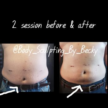 Body Sculpting By Becky - Same customer, second session results. Procedures: Wood Therapy & Laser Lipo. - Body Contouring Near Me Body Sculpting By Becky - Same customer, second session results. Procedures: Wood Therapy & Laser Lipo. - Body Contouring Near Me