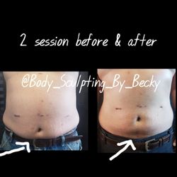 Body Sculpting By Becky - Same customer, second session results. Procedures: Wood Therapy & Laser Lipo.