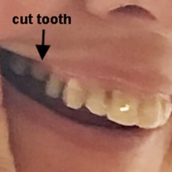 Chesterfield Smiles Dentistry - Cut molar #3. - General Dentistry Near Me - Chesterfield, Missouri Chesterfield Smiles Dentistry - Cut molar #3. - General Dentistry Near Me - Chesterfield, Missouri