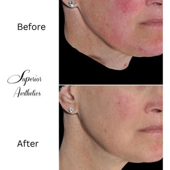 Superior Aesthetics - Rosacea Treatment in Marquette - Medical Spas Near Me - Marquette, Michigan Superior Aesthetics - Rosacea Treatment in Marquette - Medical Spas Near Me - Marquette, Michigan