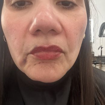 Ariava Brows & Beauty - Filler mistakes - Permanent Makeup Near Me - Park Ridge, Illinois