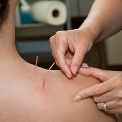 Physiomobility Don Mills - Acupuncture