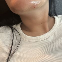 After multiple rounds of cleaning and aloe. Simran made sure to cut me up with her thread.