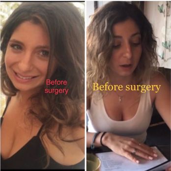 Robert Kotler, MD FACS - Before surgery - Cosmetic Surgeons Near Me - Beverly Hills, California Robert Kotler, MD FACS - Before surgery - Cosmetic Surgeons Near Me - Beverly Hills, California