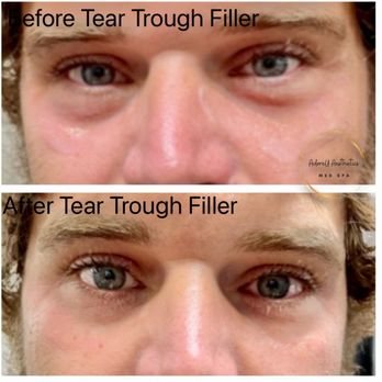 AdoreU - 1 syringe total in tear trough area - Medical Spas Near Me - O'fallon, Missouri AdoreU - 1 syringe total in tear trough area - Medical Spas Near Me - O'fallon, Missouri