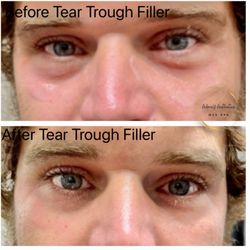 AdoreU  - 1 syringe total in tear trough area