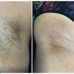 Kalei Esthetics - Underarm wax