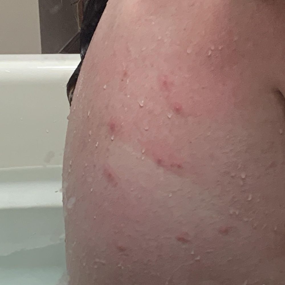Quality Inn Alexis Rd - We are all but up from our stay and hotel staff just disregarded and said "no we dont have bed bugs" smh - Hotels Near Me - Toledo, Ohio Quality Inn Alexis Rd - We are all but up from our stay and hotel staff just disregarded and said "no we dont have bed bugs" smh - Hotels Near Me - Toledo, Ohio