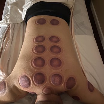 Lucky Foot Spa - After cupping, even I had the girl to take them off prematurely because the room was too hot. - Massage Near Me - Oakland, California