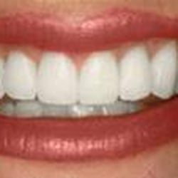 "Whitening"