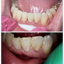 Woodside Family Dental - Veneers