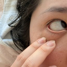 Bloodshot eyes and lashes not lifted