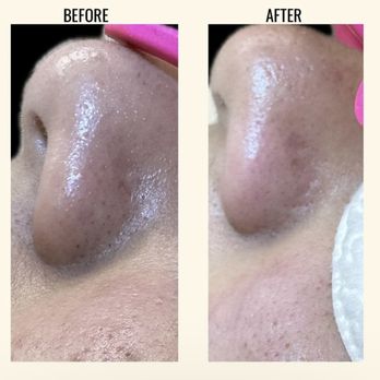 Skinby Sierarose - BEFORE & AFTER
blackhead removal - Skin Care Near Me - Livermore, California Skinby Sierarose - BEFORE & AFTER
blackhead removal - Skin Care Near Me - Livermore, California