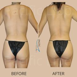 Pacific Lipo - Newport Beach - Back lipo