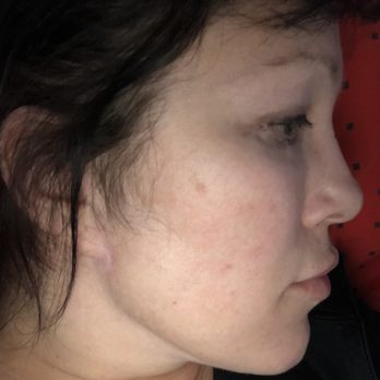 Metropolitan Plastic Surgery - One side of my face were the maxilla muscle has fallen off the bone - Cosmetic Surgeons Near Me - St Louis, Missouri Metropolitan Plastic Surgery - One side of my face were the maxilla muscle has fallen off the bone - Cosmetic Surgeons Near Me - St Louis, Missouri