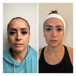 State of Zionna - Six-week Sculptural Face Lifting results. My client received one treatment for six weeks, and these are the magical results!