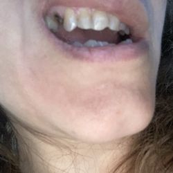 Hollywood Smile Dental - Nadia E Taheri DDS - This is the tooth that fell off