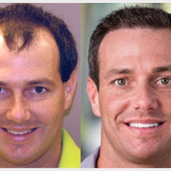Chris For Hair - Looks 10 years younger! - Hair Loss Centers Near Me Chris For Hair - Looks 10 years younger! - Hair Loss Centers Near Me