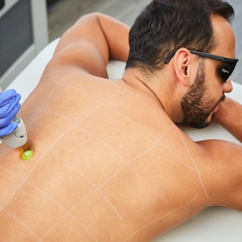 Ideal Image Indianapolis - Laser Hair Removal Near Me - Indianapolis, Indiana Ideal Image Indianapolis - Laser Hair Removal Near Me - Indianapolis, Indiana