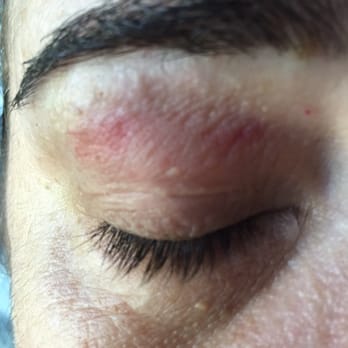 Escape Nails and Spa - This is a picture of my eyelid after it was burned when I had a brow wax. - Nail Salons Near Me - Henrico, Virginia Escape Nails and Spa - This is a picture of my eyelid after it was burned when I had a brow wax. - Nail Salons Near Me - Henrico, Virginia