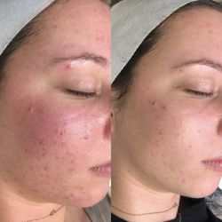 Traveling Spa Girl - Face Reality acne bootcamp graduate