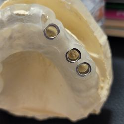 Lopez Dream Smiles - This is guided dental implant guide to place implants in a conservative non invasive manner!!