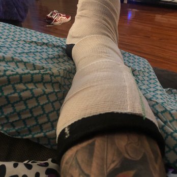 Pacific Orthopaedic Associates - Dislocated ankle and fibular fracture - Physical Therapy Near Me - Alhambra, California Pacific Orthopaedic Associates - Dislocated ankle and fibular fracture - Physical Therapy Near Me - Alhambra, California