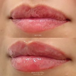 Bellissima Skin - Lip Filler