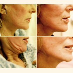 Nayiri Doudikian-Scaff, MD - Face lift
