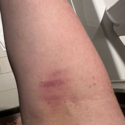 Urgent Medical Care of Cumberland - This was my arm after I had my blood draw done.