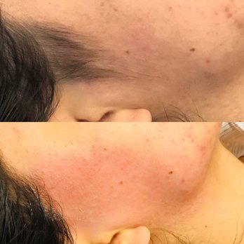 Get Beautified - Sideburn Wax Before & After - Skin Care Near Me - San Leandro, California Get Beautified - Sideburn Wax Before & After - Skin Care Near Me - San Leandro, California